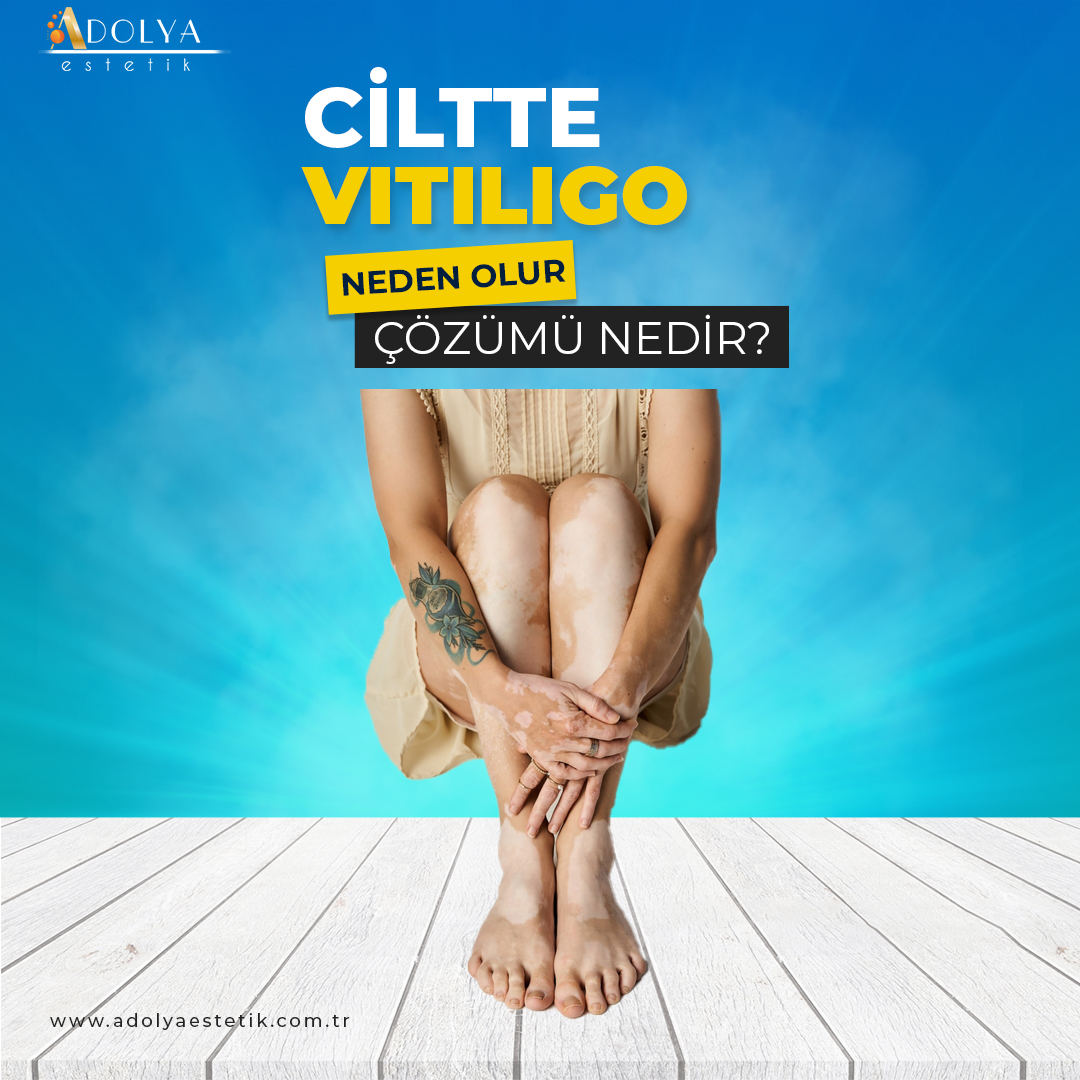 Vitiligo 