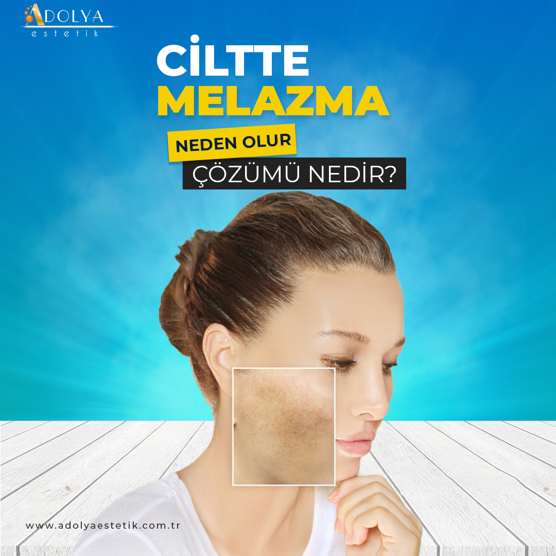 Melazma