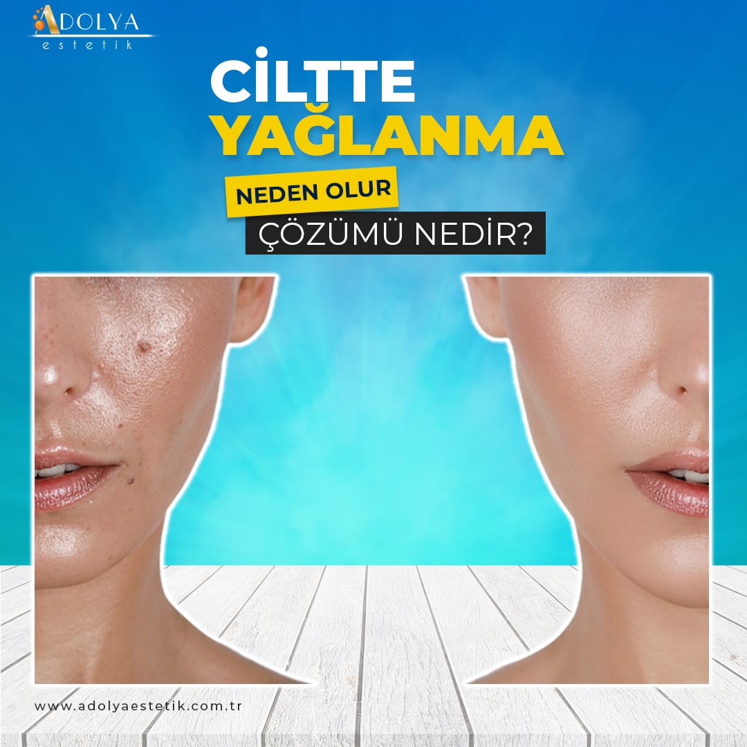Ciltte Yağlanma